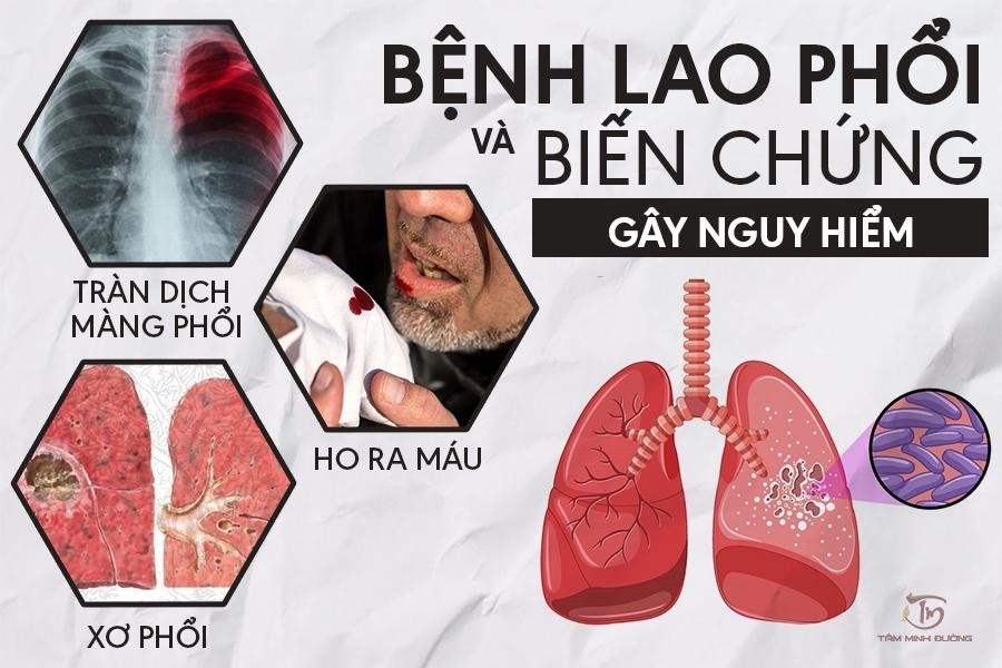 TRUYỀN THÔNG VỀ BỆNH LAO VÀ NHỮNG ĐIỀU CẦN BIẾT